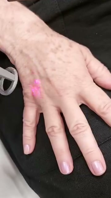 Sessão real de Laser Lavieen da Dra. Patrícia Leite