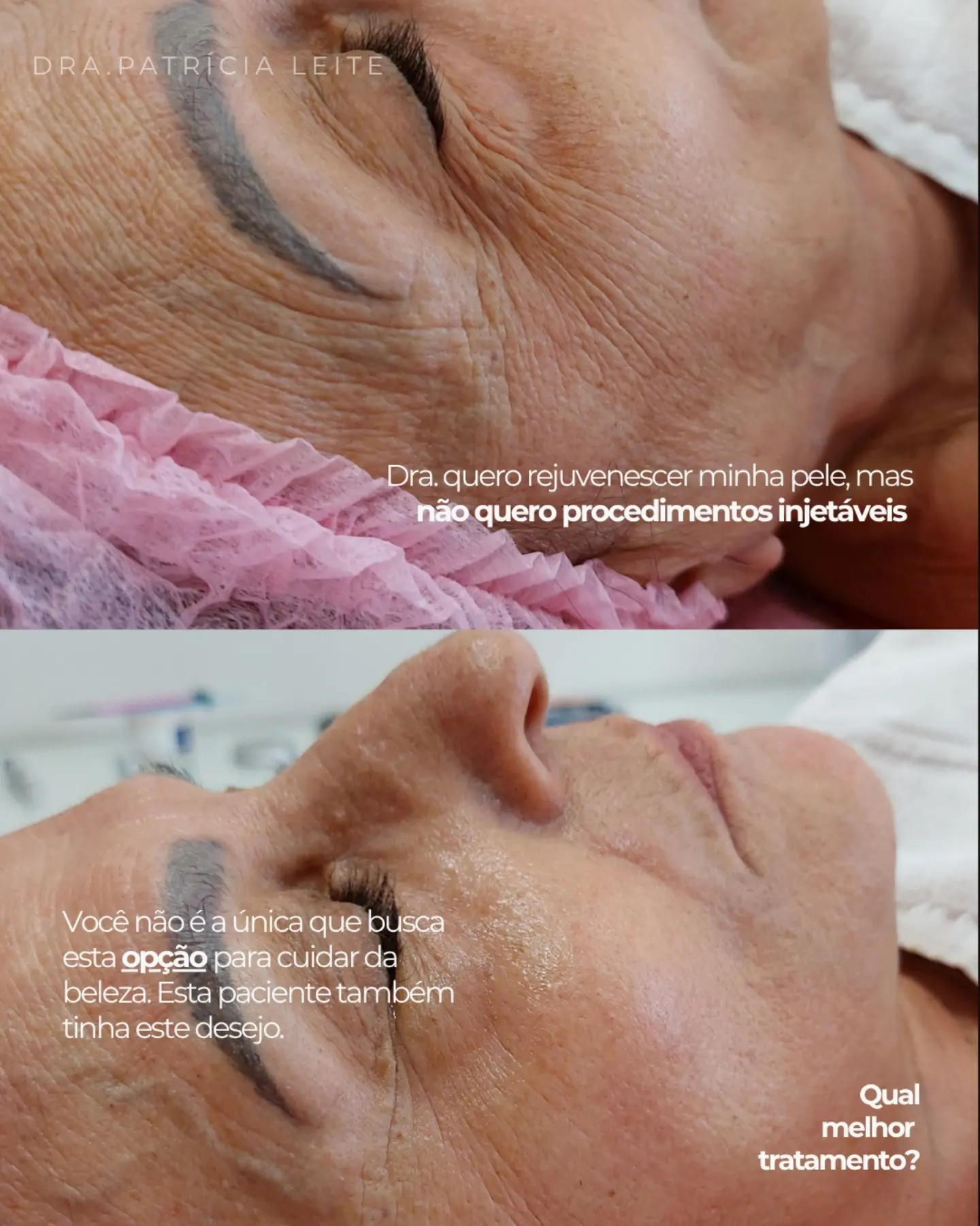 Antes e depois real de rejuvenescimento de pele publicado pela Dra. Patrícia