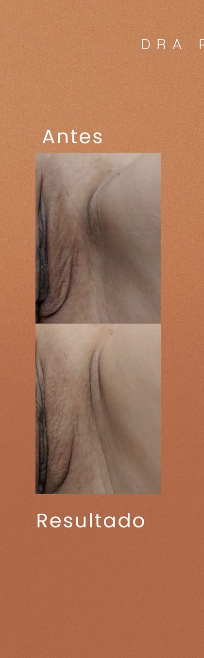 Antes e depois real de preenchimento íntimo publicado pela Dra. Patrícia
